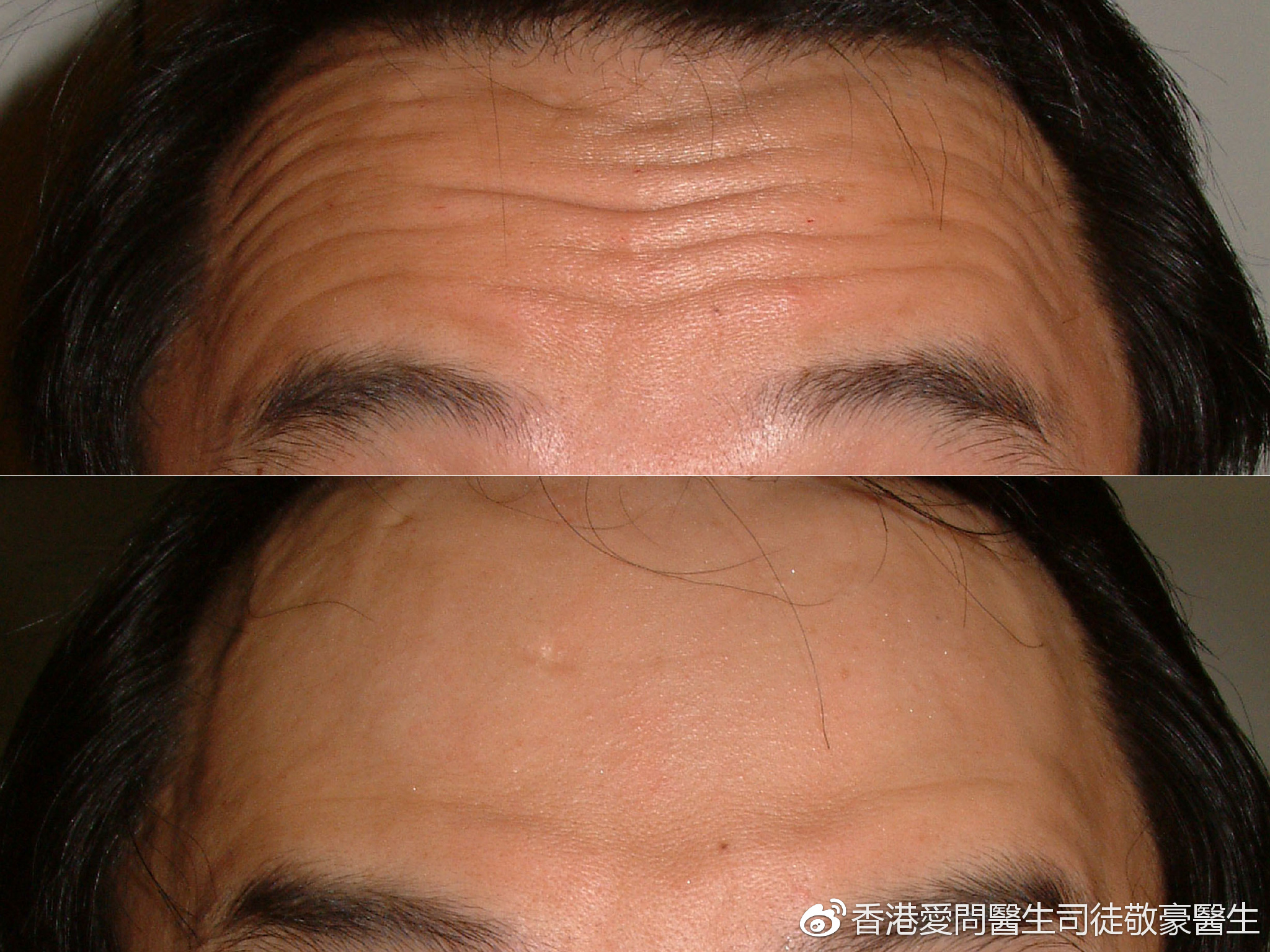 由脸部表情肌肉长期收缩所致;如抬头纹,鱼尾纹,眉间纹,鼻根部横纹