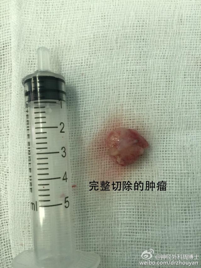 “腿麻”不都是腰椎间盘突出的事 不要忘了肿瘤