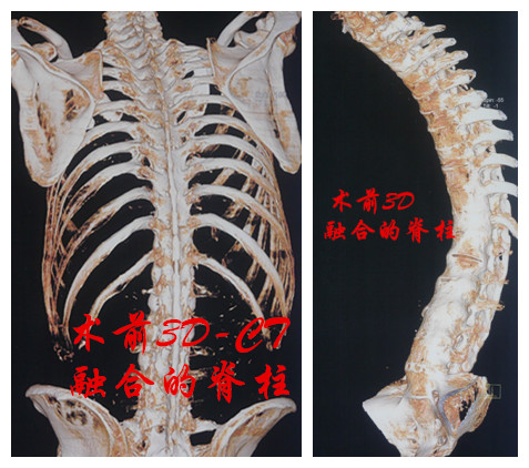 告別駝背挺直腰桿聆聽強直性脊柱炎伴後凸患者的心聲