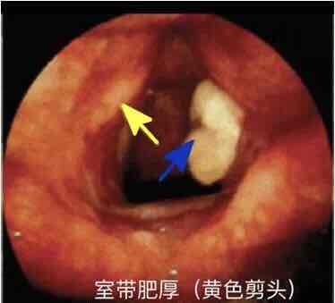 一些辅助检查也能较好地协助诊断此类疾病,像电子喉镜检查:可见杓状