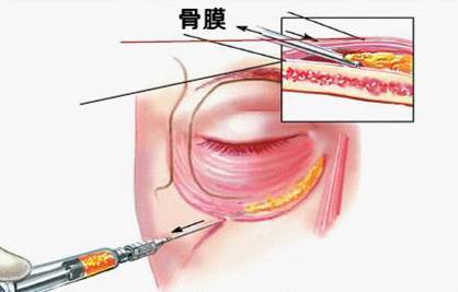 淚溝韌帶處進行點狀堆積注射,在皮下或眼輪匝肌下進行鈍針剝離並進行