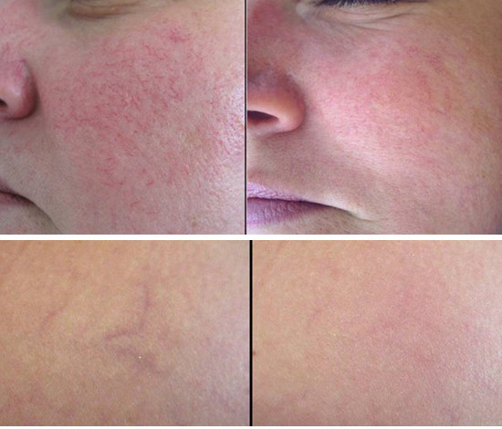 脸部双颊发红并且有鸡皮肤(脸颊两侧有鸡皮肤还有红血丝) 脸部双颊发红并且有鸡皮肤(脸颊两侧有鸡皮肤还有红血丝)