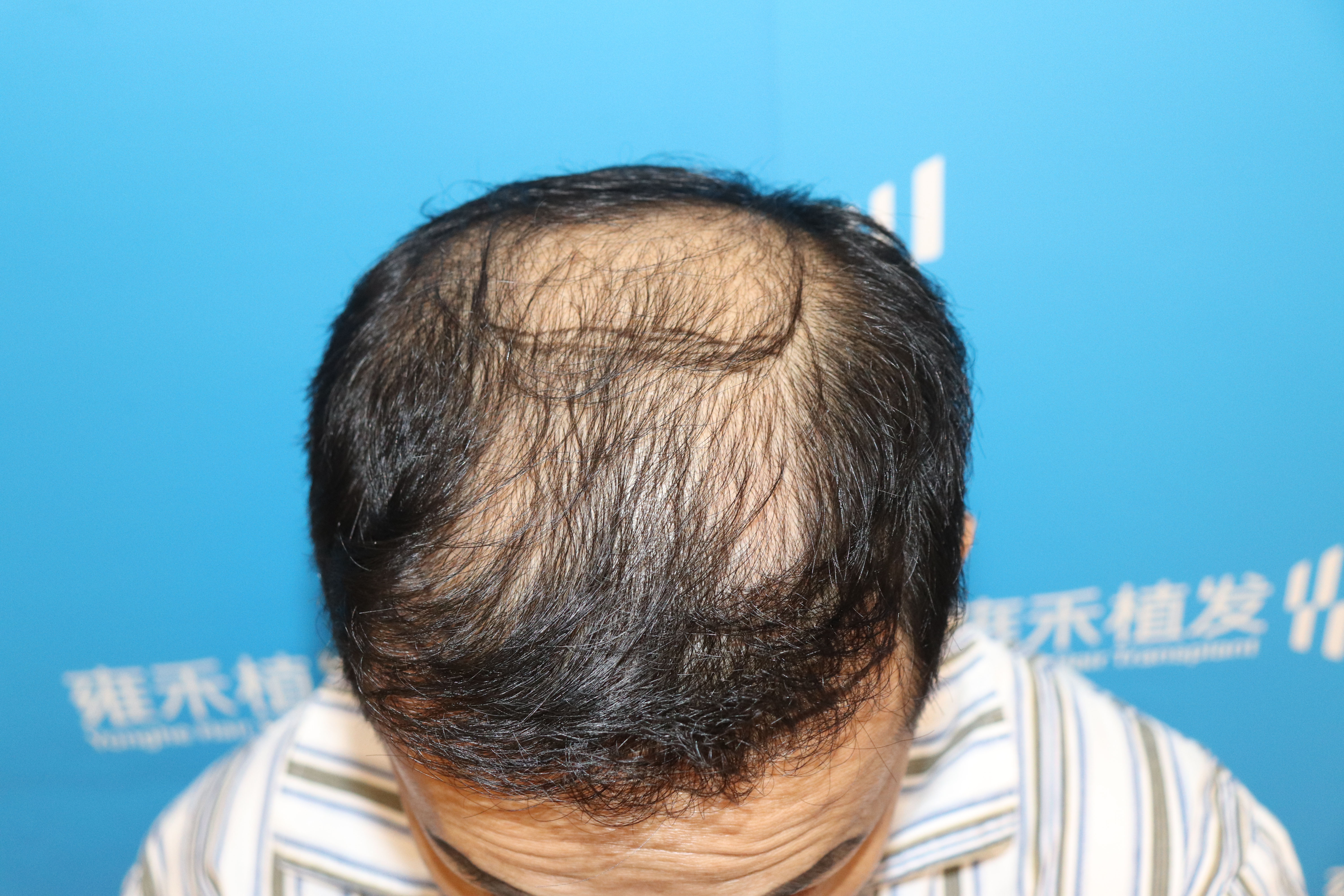 雍禾植发案例--3612单位发际线种植