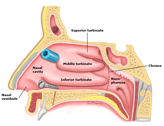 鼻腔异物最常位于鼻腔通道底部恰好在下鼻甲下方,或者位于鼻腔上方