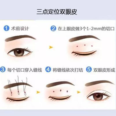 线结埋入过浅,易外露或形成小囊肿,如果又想做双眼皮只能采取全切进行