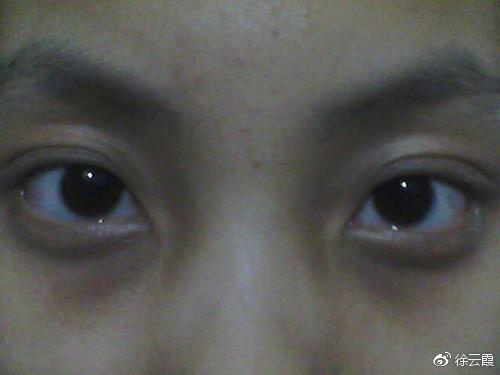 解决黑眼圈问题,真正靠谱的方法有哪些?