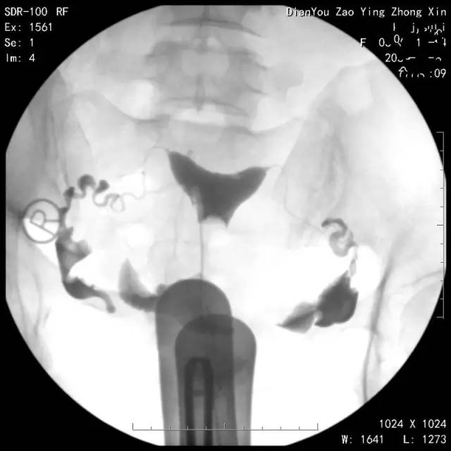 360度全方位揭秘输卵管碘油造影!