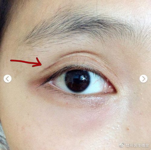 【整形医生傅荣】上睑凹陷的造成原因及治疗方法!