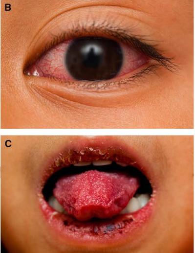 儿童发热,皮疹,心脏病----小心川崎病(下)