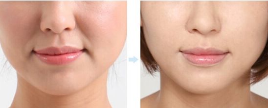 法令纹鼻沟纹让女性至少增加5岁面龄的三八线