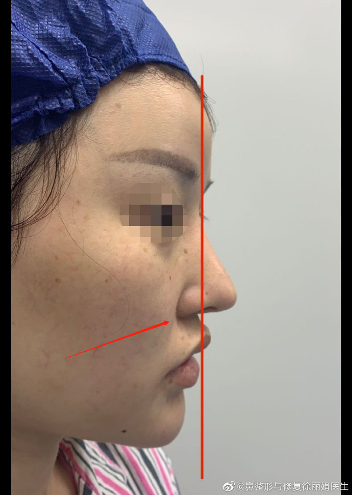 如何区分是鼻基底凹陷还是法令纹太深?-徐丽娟主治医师-爱问医生