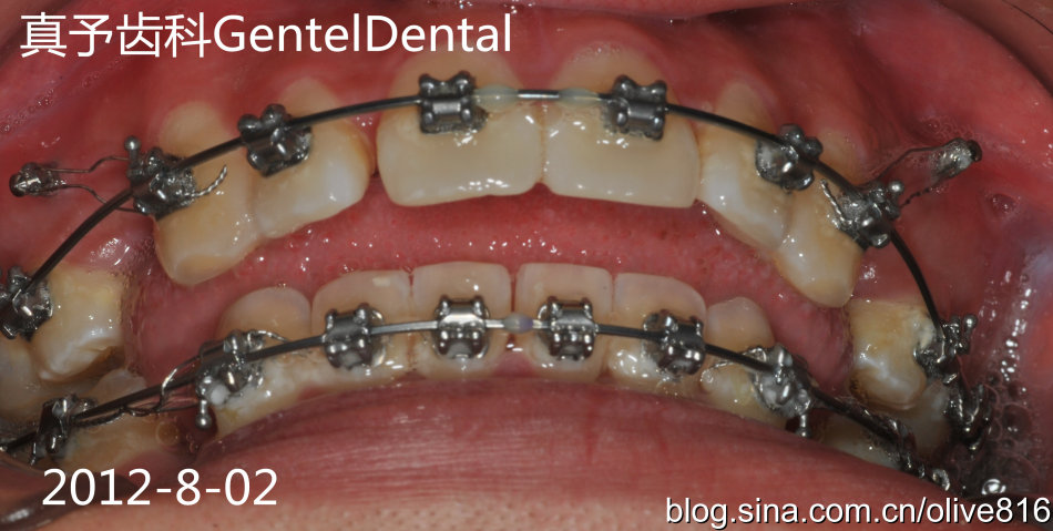 成年开合伴下颌后缩睡眠呼吸障碍矫治加咬合调整一例--爱问医生