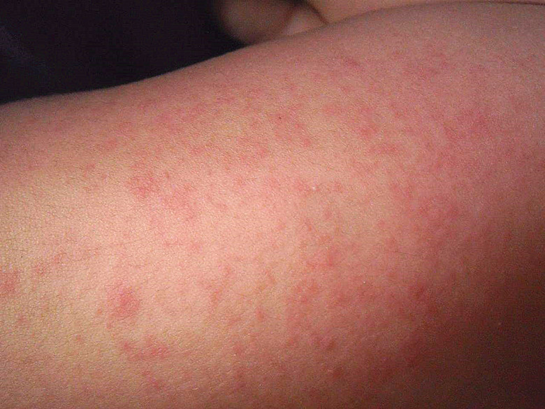 一,孩子食物过敏表现症状