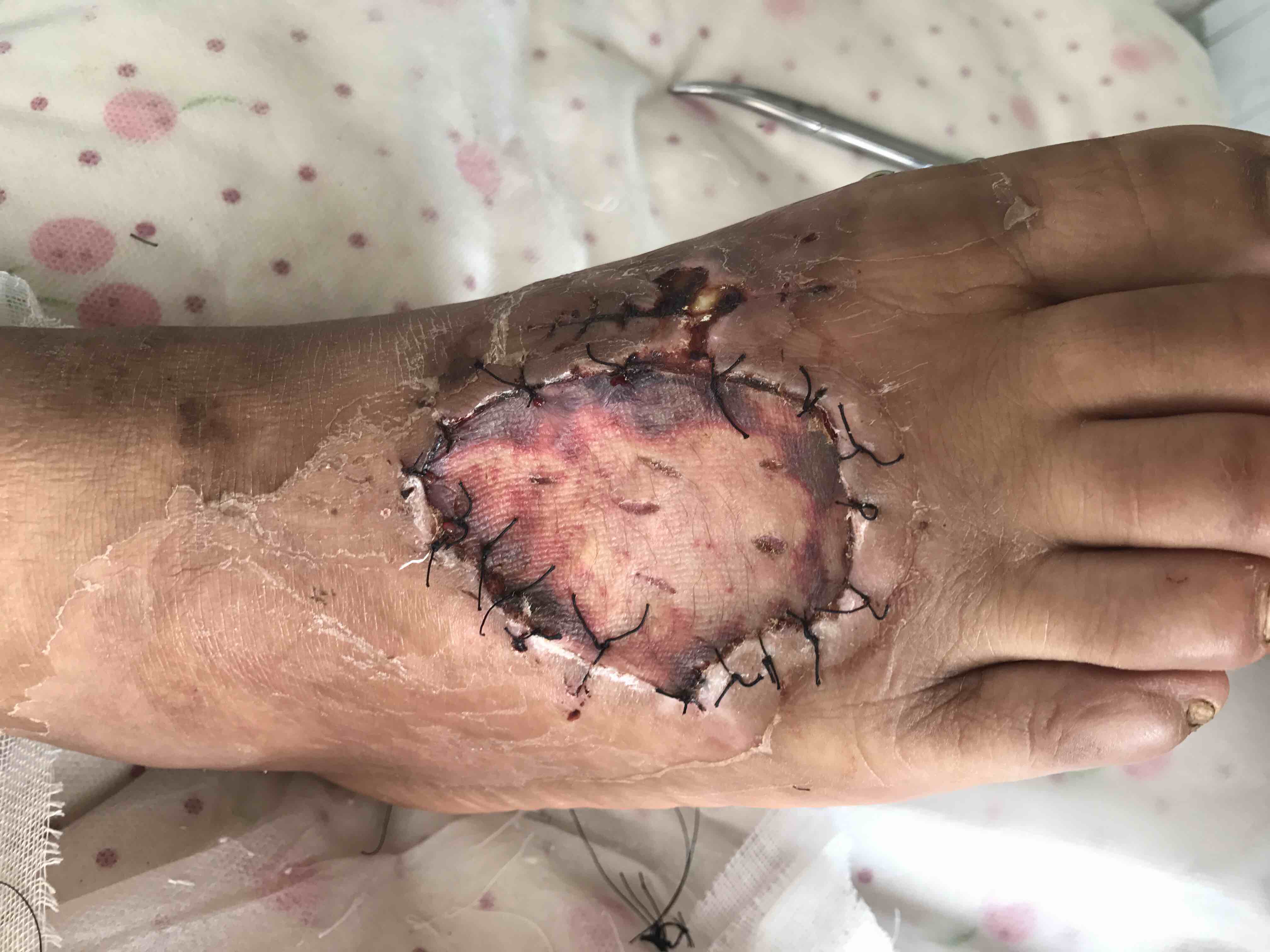 多发跖骨骨折伴局部皮肤软组织坏死的处理_王宝猛_主治医师_爱问健康