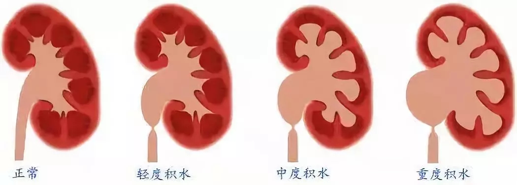 肾积水的原因(肾积水的原因有哪些)-第2张图片-鲸幼网