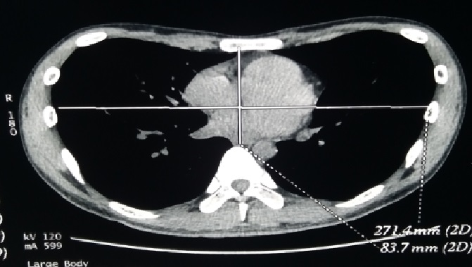 结核性胸膜炎后大面积漏斗胸合并扁平胸手术