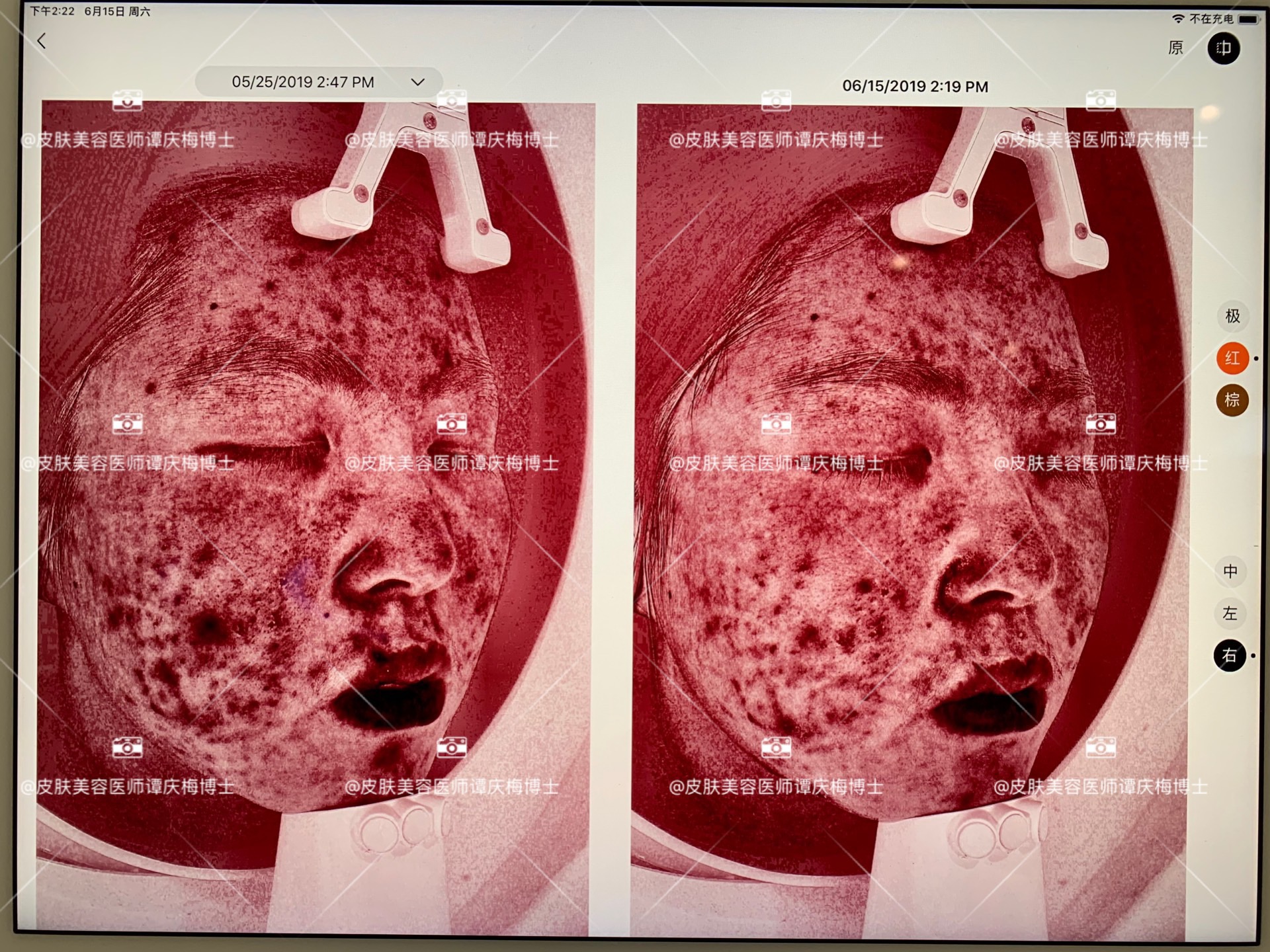 脸上长痘痘，毒素太多是诱因？医生说：痤疮的原因不超过4个会长痤疮的原因