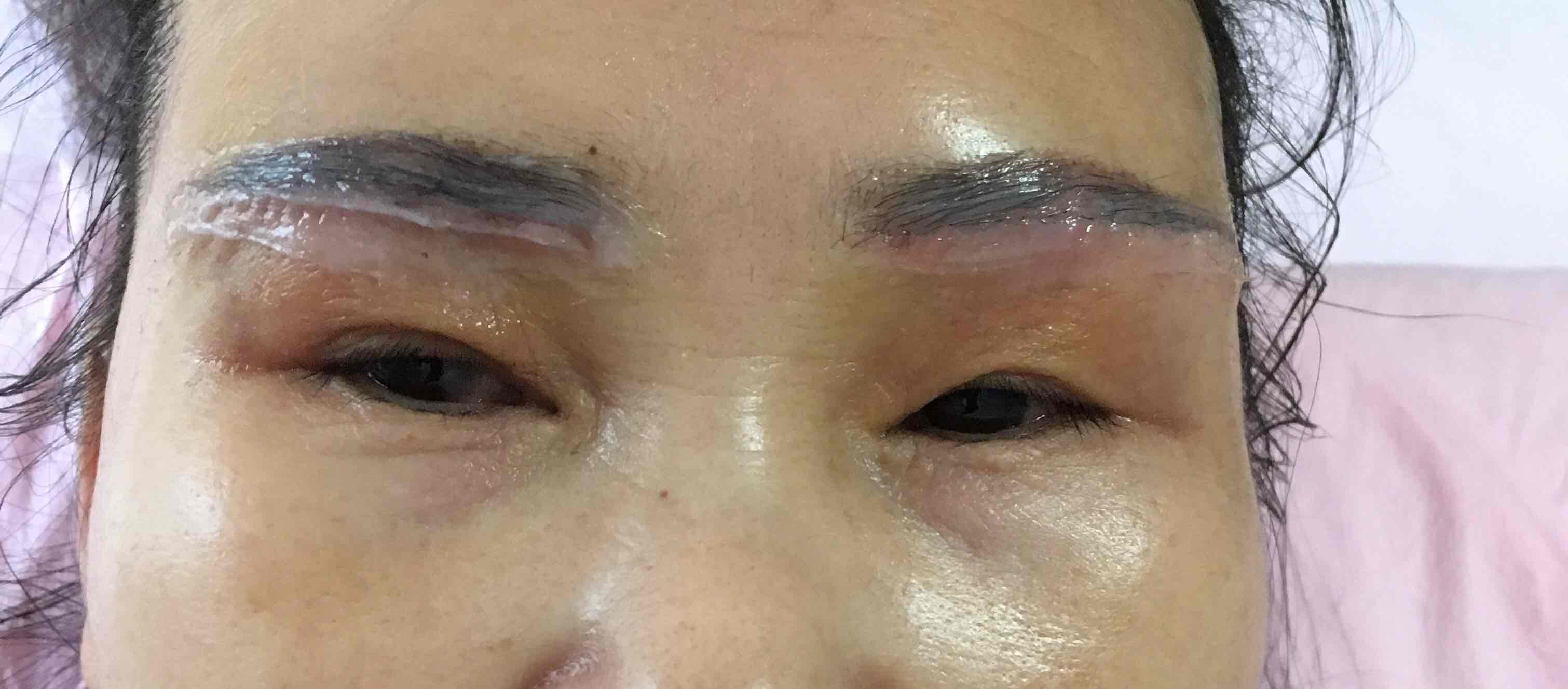 老年性上睑皮肤松弛的治疗策略-臧梦青副主任医师-爱问医生