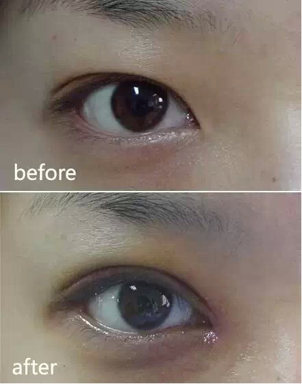 要不要开内眼角对照一下