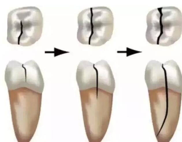 "牙隐裂"是什么?该怎样治疗?