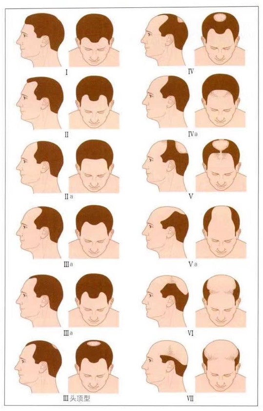 男性脱发(mphl)和女性脱发(fphl)临床表现