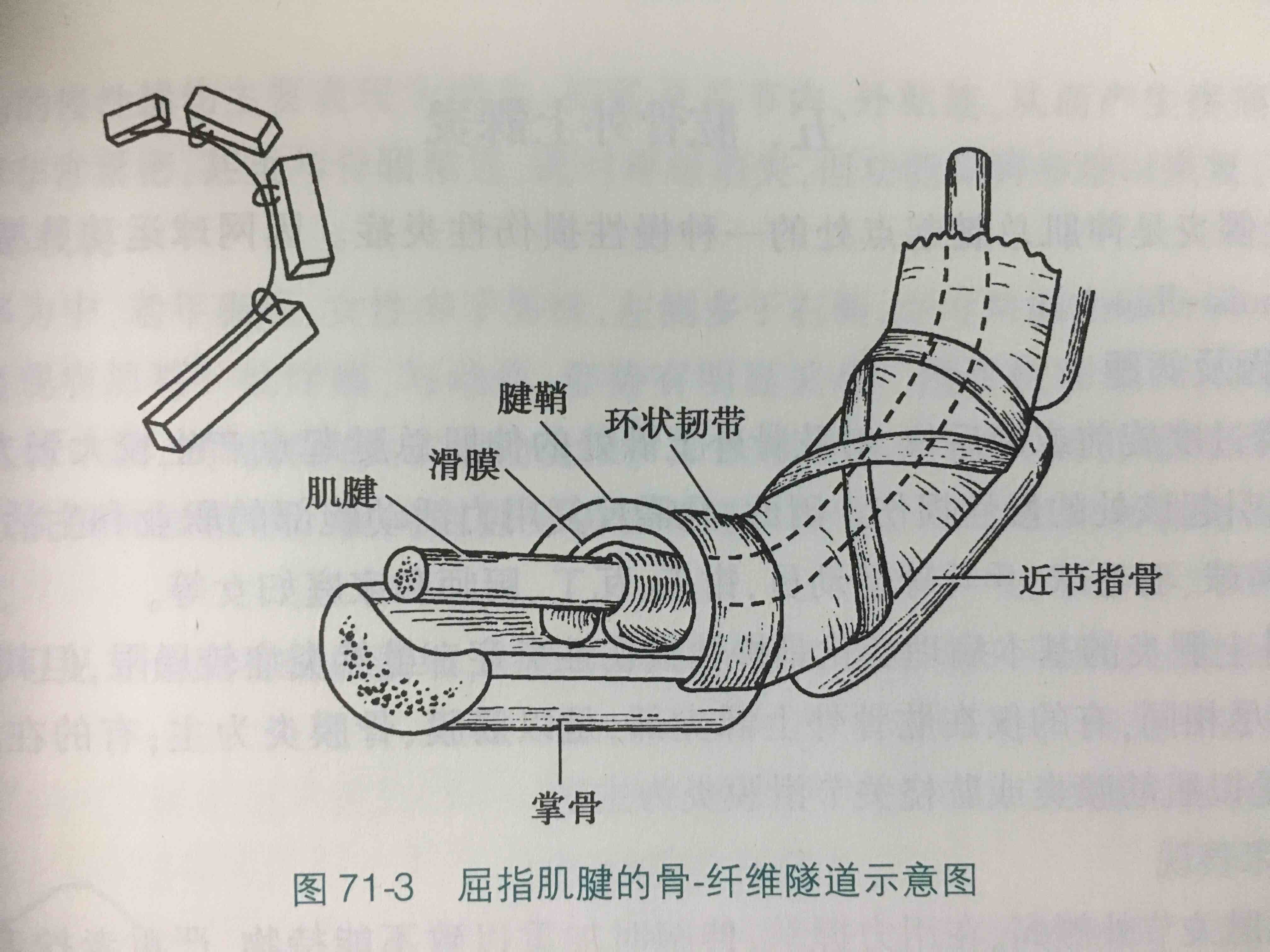 腱鞘炎-手机奴们的雷区