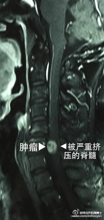 “腿麻”不都是腰椎间盘突出的事 不要忘了肿瘤