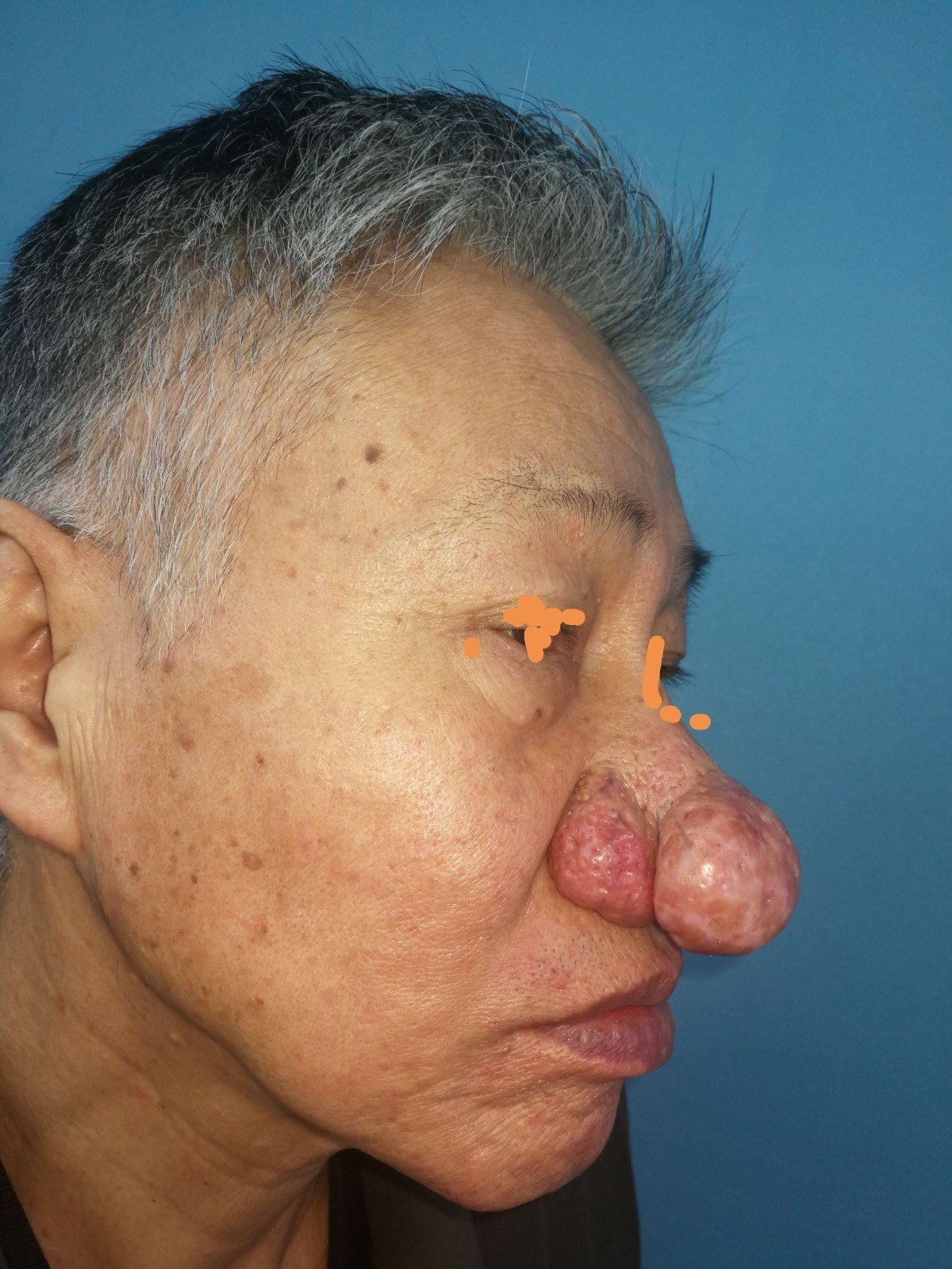 手术成功治疗一例严重老年酒渣鼻患者的经验介绍