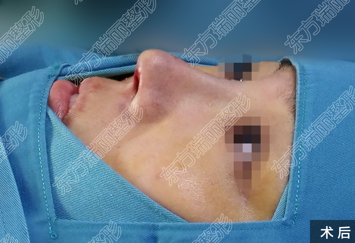 如果双侧耳软骨都取过了,鼻尖可以用异体骨做