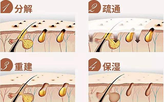 鸡皮肤果酸换肤有效吗(果酸换肤去鸡皮肤前后对比)