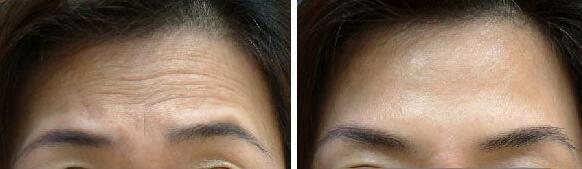 祛除额部皱纹祛除鱼尾纹祛除鱼尾纹通过术后3~6个月随访受术者皱纹