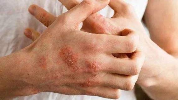 奇痒无比一到夏天手上长满小水泡答案如此简单