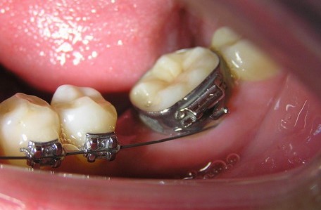 结扎丝是将托槽和钢丝(主弓丝)结扎成一个连续的整体的不锈钢丝, 结扎