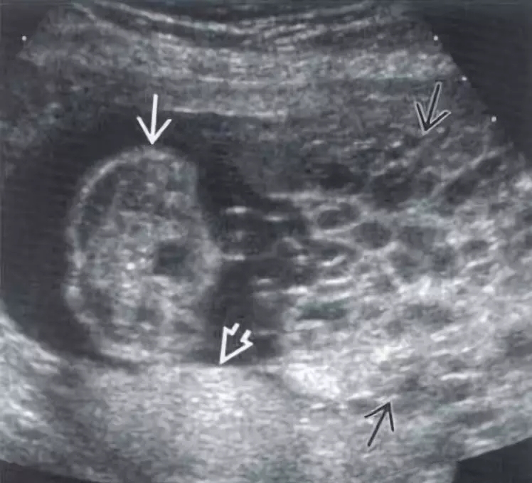 完全性葡萄胎侵袭性葡萄胎部分性葡萄胎葡萄胎,nos恶性葡萄胎