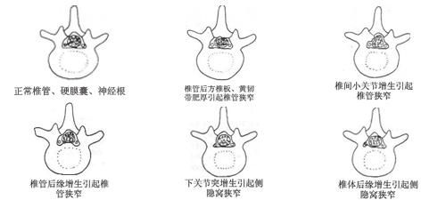 04小關節紊亂在上下兩個椎骨的後面,存在被軟骨覆蓋,並被關節囊包繞的