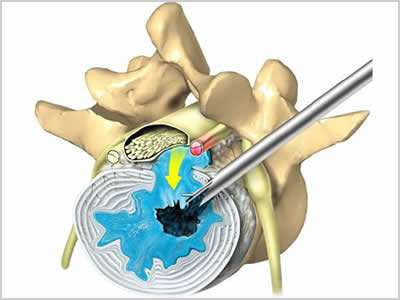 颈椎病椎间孔镜7mm小伤口手术治疗