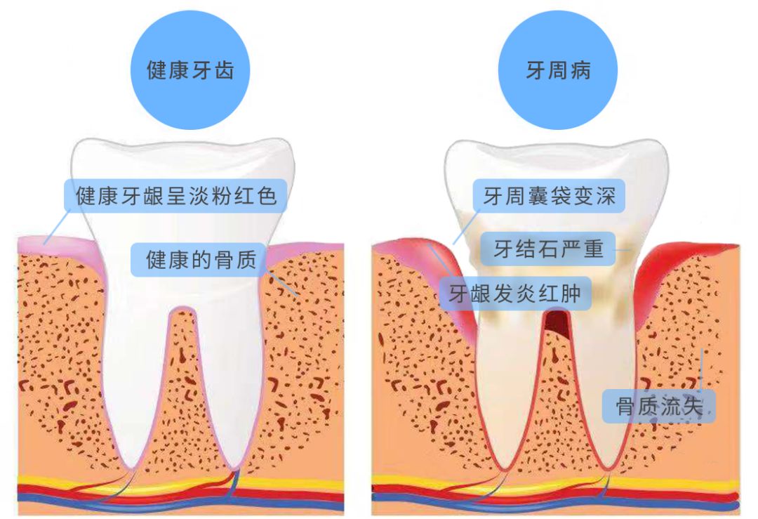 牙周膜附着在牙槽骨和牙根面的牙骨质上,形成一个完整的系统,叫牙周.
