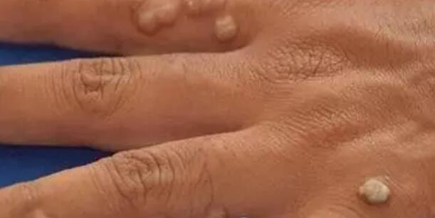 什么是人类乳头瘤病毒?