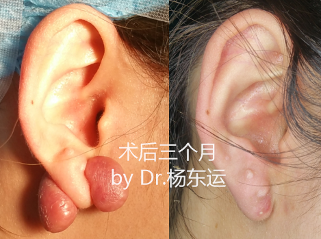 对于已经明显增生的耳垂疤痕疙瘩,应该采用手术切除 放疗(电子线