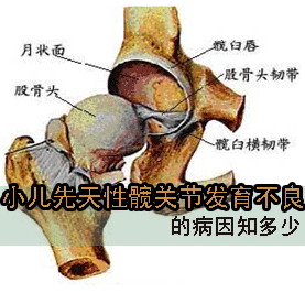 再聊孩子腿纹不对称的问题