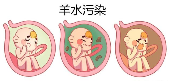 过了预产期的孕妈该怎么办?