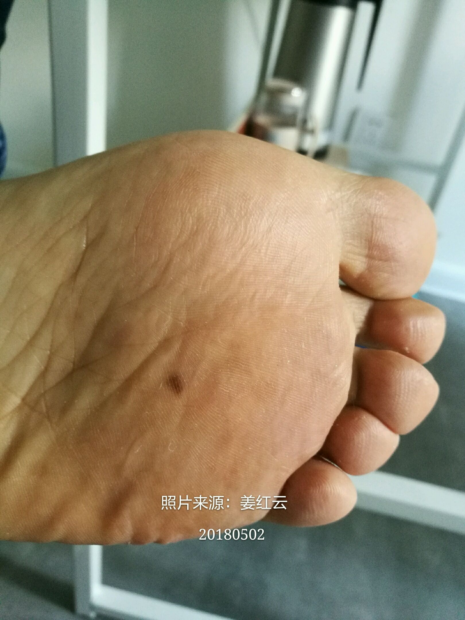 足底突然发现黑色斑片是什么情况