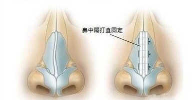 如何讓歪鼻改