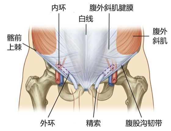 直疝是直的斜疝是斜的