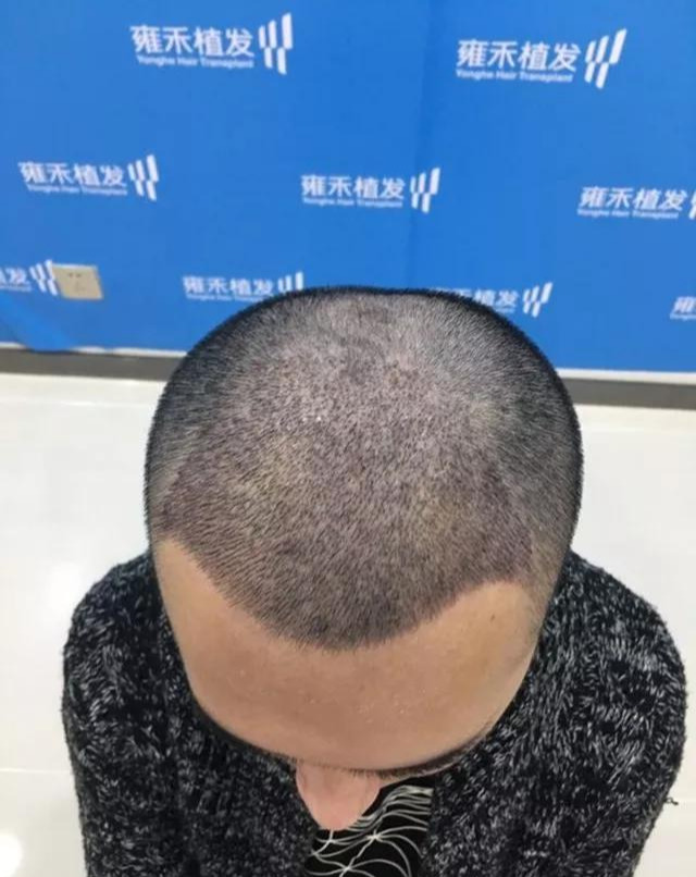 公立医院医生脱发来民营医院植发1年帅形象欢喜结婚