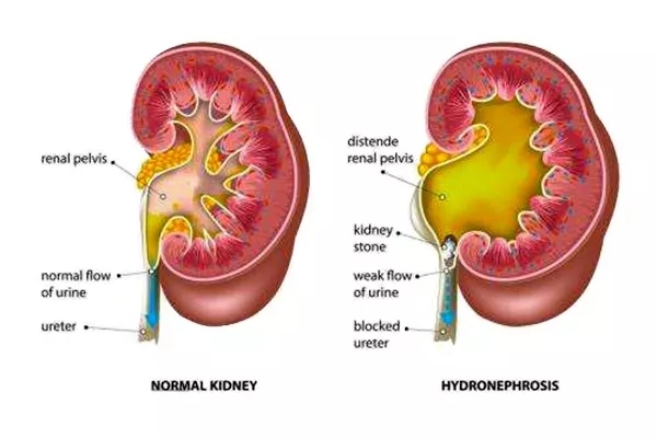 肾积水危害大,别小瞧!