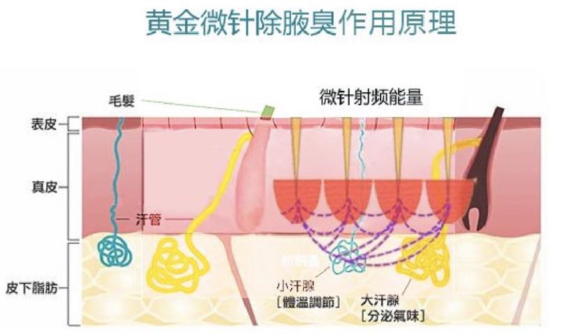 "腋臭福音"—感受精准无痕黄金微针给你带来的芬芳夏季