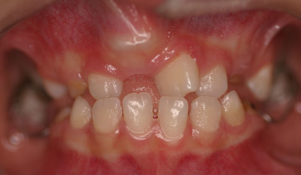 多生牙多为畸形牙,它们占据了正常牙的位置,致使正常的牙齿出现错位或