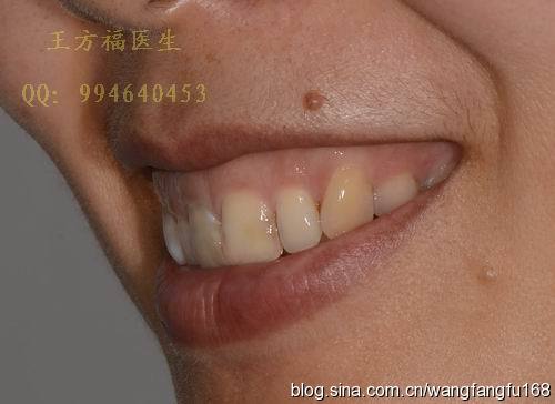 高位笑线,邻面龋-瓷贴面修复病例 /三亚王方福医生