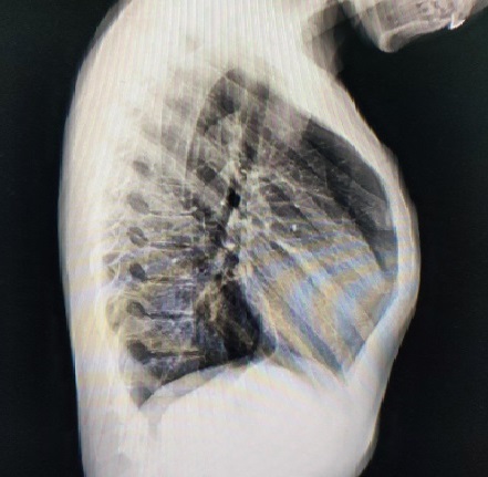 女性重度鸡胸的wenlin手术